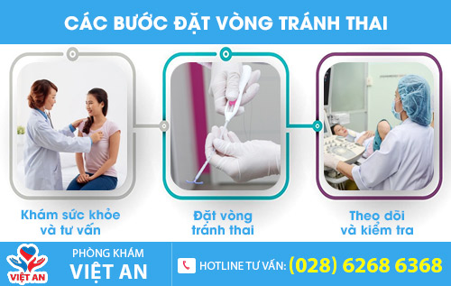 Các bước đặt vòng tránh thai