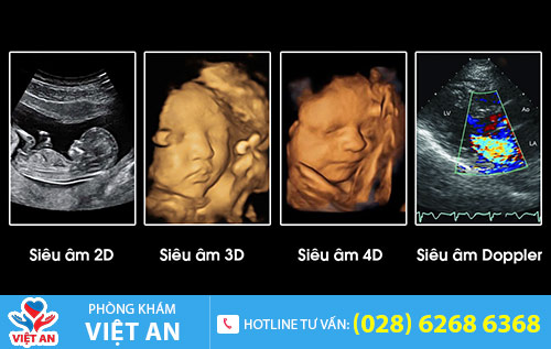 Các hình thức siêu âm