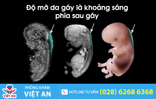 độ mờ da gáy